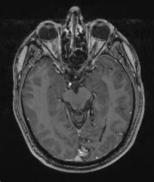 18A1 AVM (Case 18) T1 - Copy