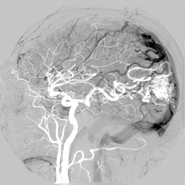 18A2 AVM (Case 18) MRI Angiogram 1