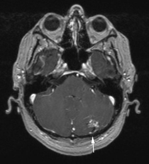 19A1 repeat AVM (Case 19) hybrid vessels T1 W 1 copy - Copy