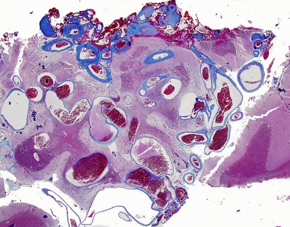 19C1 AVM (Case 19) hybrid vessels Trichrome 2X