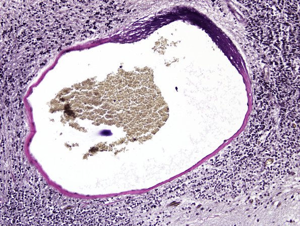 19D3 AVM (Case 19) hybrid vessels VVG 5