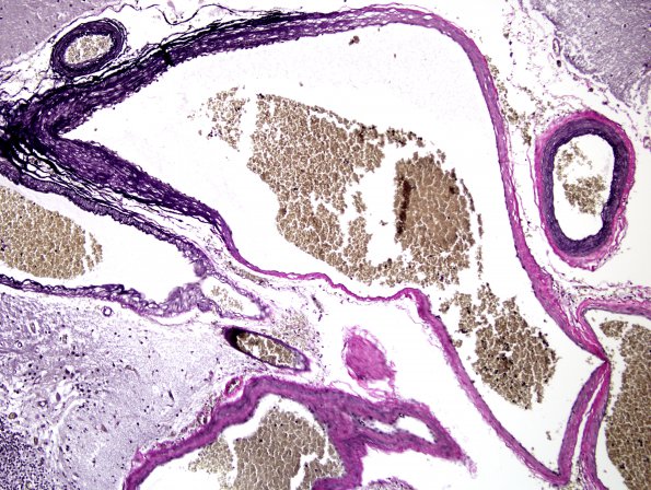 19D4 AVM (Case 19) hybrid vessels VVG 4