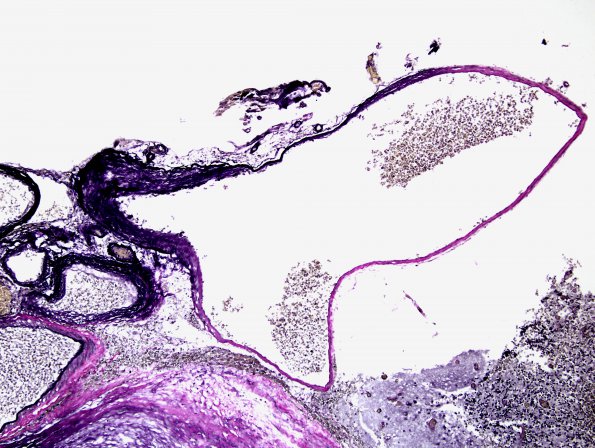 19D5 AVM (Case 19) hybrid vessels VVG 2