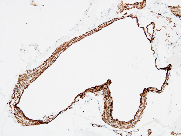 19E2 AVM (Case 19) hybrid vessels SMA 1