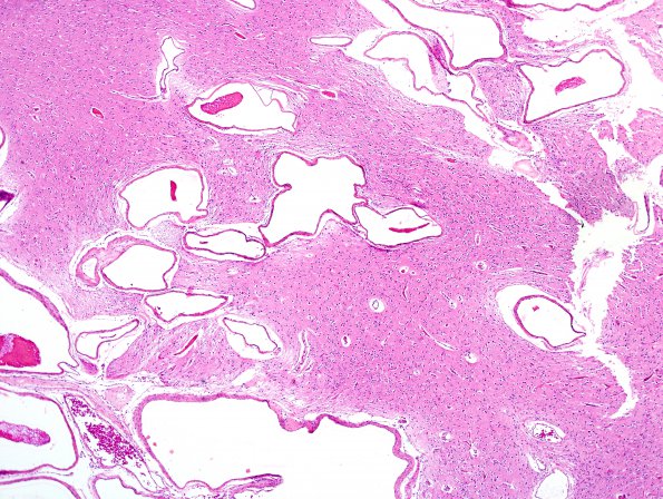 1B2 AVM (Case 1) H&E 4