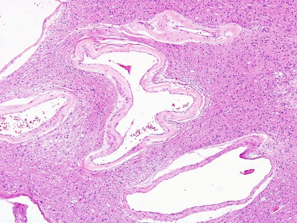 1B3 AVM (Case 1) H&E 1