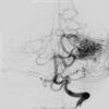 20A2 AVM (Case 20) MRI Angiogram 2