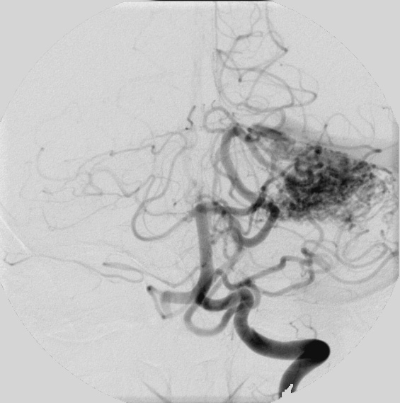 20A2 AVM (Case 20) MRI Angiogram 2