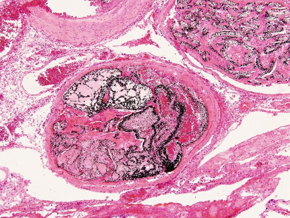 20B3 AVM (Case 20) H&E 2