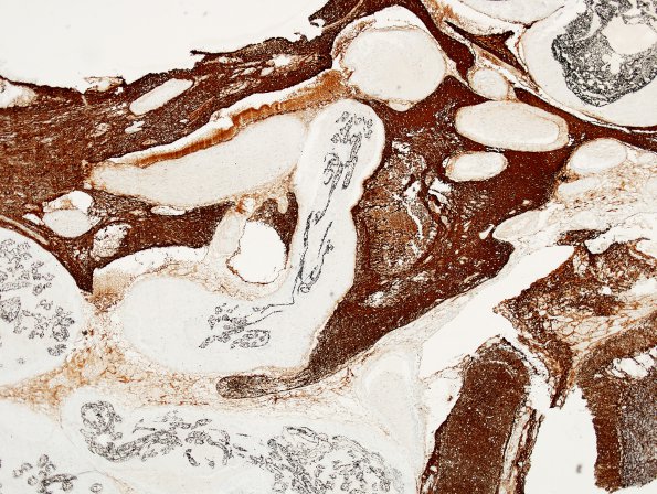 20E2 AVM (Case 20) GFAP 1