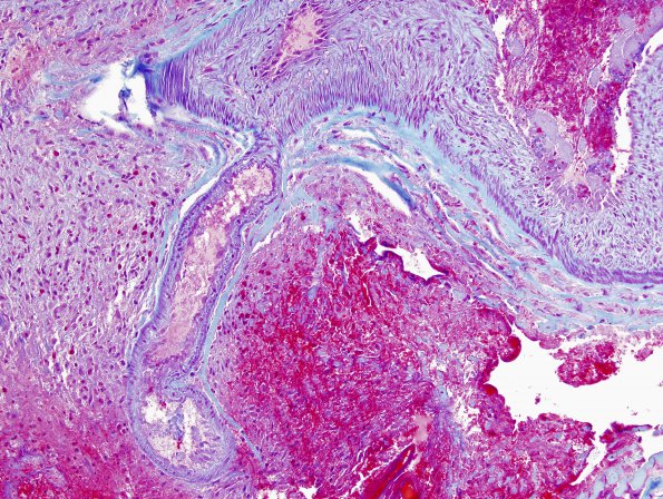 21B1 AVM (Case 21) Hybrid vessel Trichrome 2