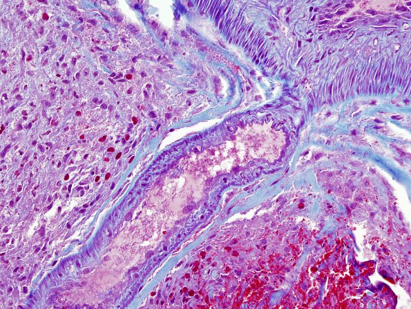 21B2 AVM (Case 21) Hybrid vessel Trichrome 1