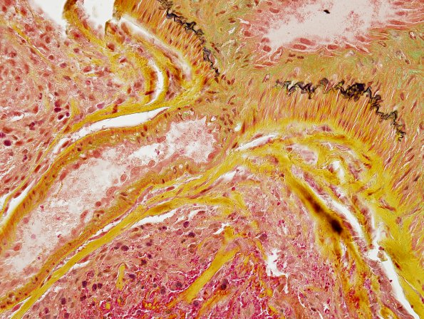 21C2 AVM (Case 21) Hybrid vessel Pentachrome 1