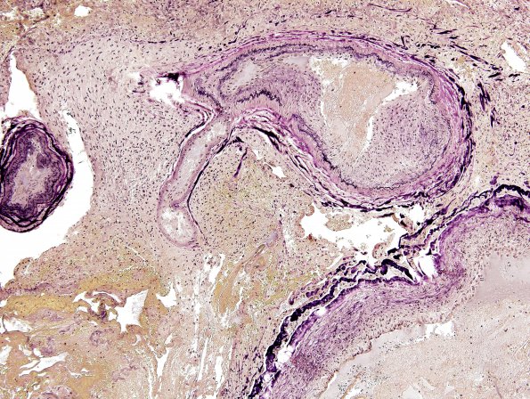 21D1 AVM (Case 21) Hybrid vessel Elastin 4