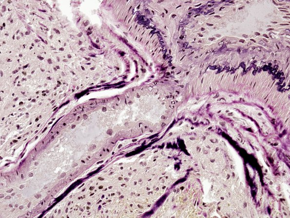 21D2 AVM (Case 21) Hybrid vessel Elastin 5.