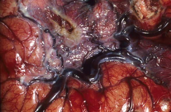 22A2 Infarct, CHD, 1 yo epilepsy (Case 22) 2