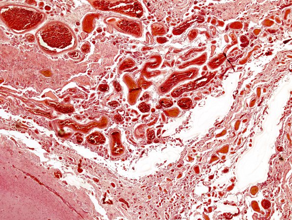 22B2 AVM, (actually PseudoAVM (S80-2848) H&E 4