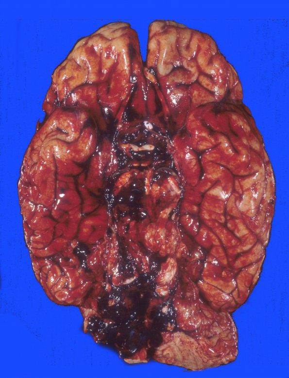 23A1 AVM, R CPA, ruptured, upward herniation cerebellum (A39796) 1