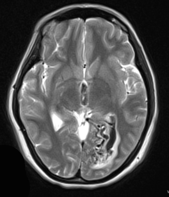 25A1 AVM (Case 25) T2 W contrast 1 - Copy