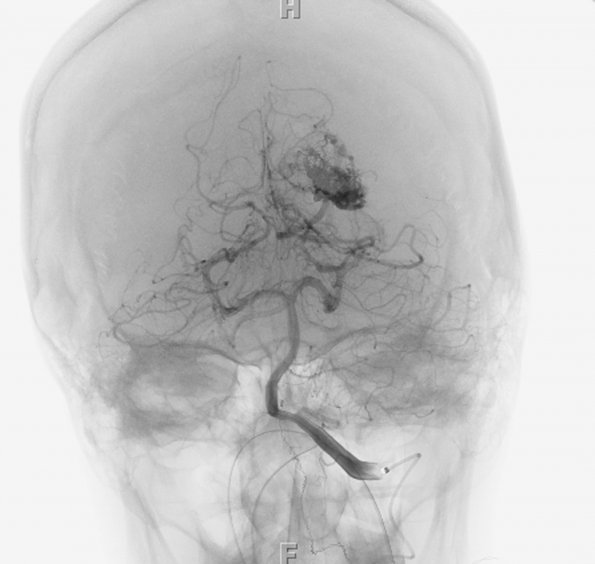 25A2 AVM (Case 25) MRI angio (embol series) 5 - Copy