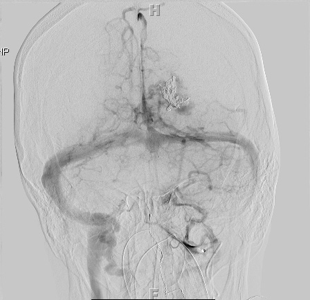 25A3 AVM (Case 25) MRI angio (embol series) 6 - Copy