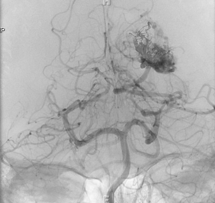 25A4 AVM (Case 25) MRI angio (Embol series) 2 - Copy
