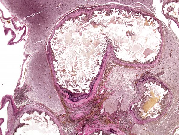 26C2 AVM (Case 26) VVG 1 PVA embolized