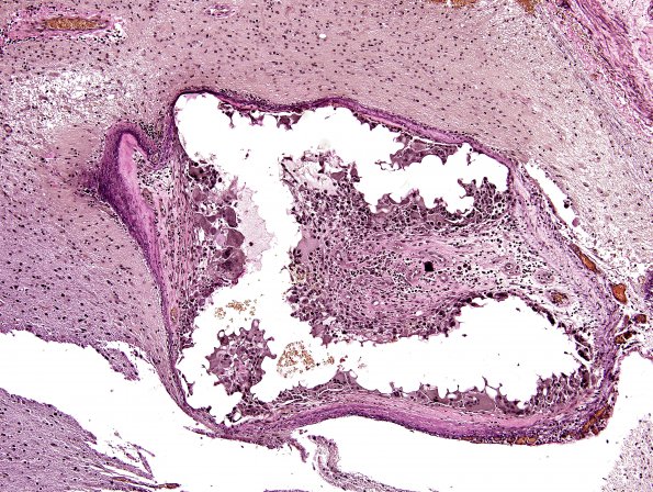 26C3 AVM (Case 26) VVG 2 embolized