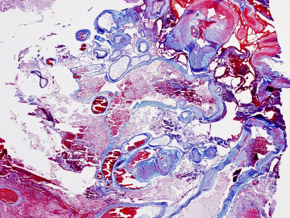 28A1 AVM (Case 28) Trichrome 1