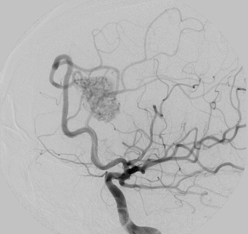 29A1 (Case 29) RICA PreEmboli angiogram - Copy