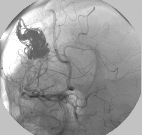 29A2 Case 29 Angiogram post - Copy