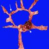 2A2 Aneurysm, multiple & AVM (Case 2) 7A copy