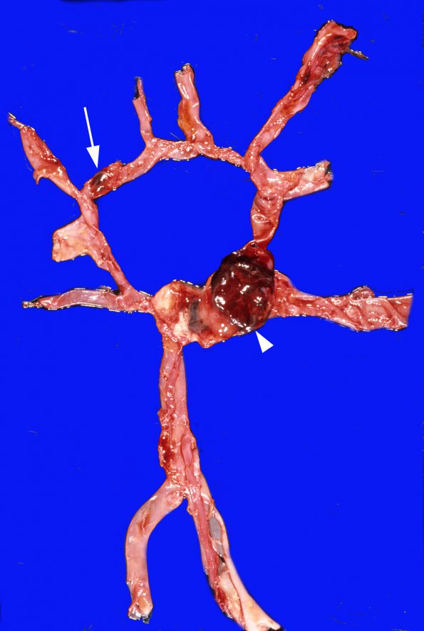 2A2 Aneurysm, multiple & AVM (Case 2) 7A copy