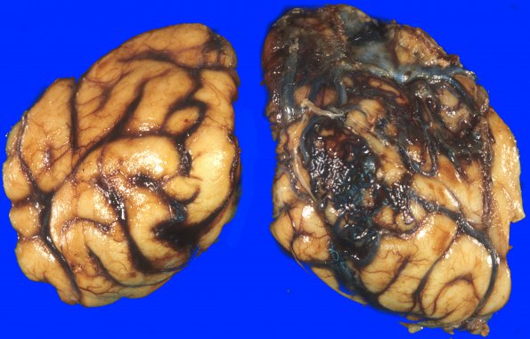 2A4 Aneurysm, multiple & AVM (Case 2) 16