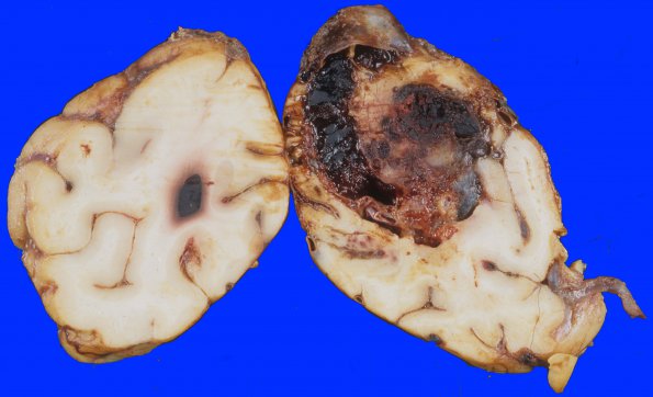 2A5 Aneurysm, multiple & AVM (Case 2) 22