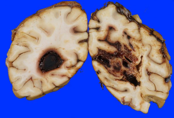 2A7 AVM (Case 2) gross 2