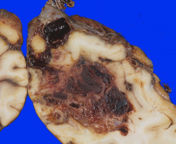 2A8 Aneurysm, multiple & AVM (Case 2) 3