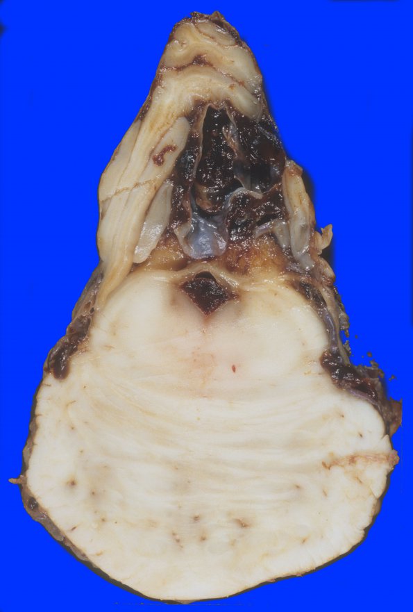 2A9 Aneurysm, multiple & AVM (Case 2) 4