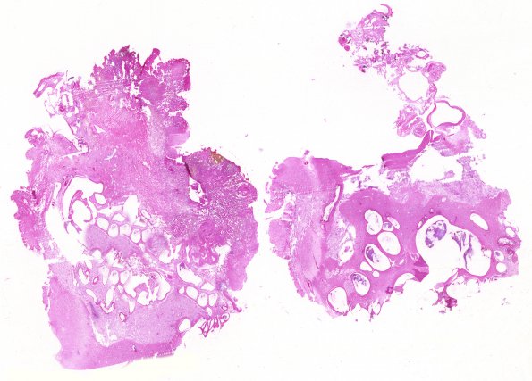 30B1 AVM (Case 30) H&E whole mount