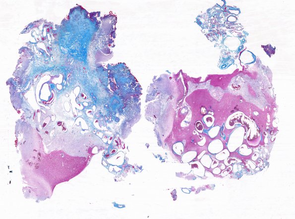 30C AVM (Case 30) Trichrome whole mount