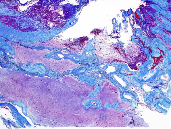 31B AVM (Case 31) Trichrome 4X