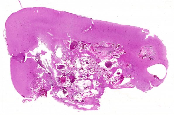 32A1 AVM (Case 32) H&E WM