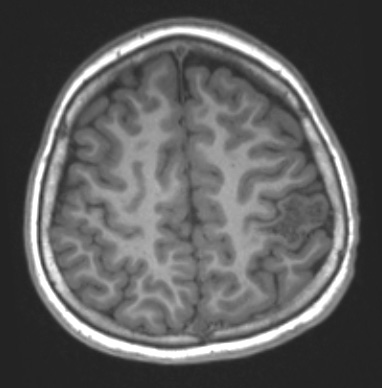 34A2 AVM, hybrid vessels (Case 34) T1NoC - Copy