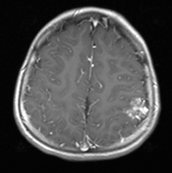 34A3 AVM, hybrid vessels (Case 34) T1W - Copy