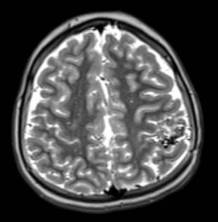 34A5 AVM, hybrid vessels (Case 34) T2W - Copy