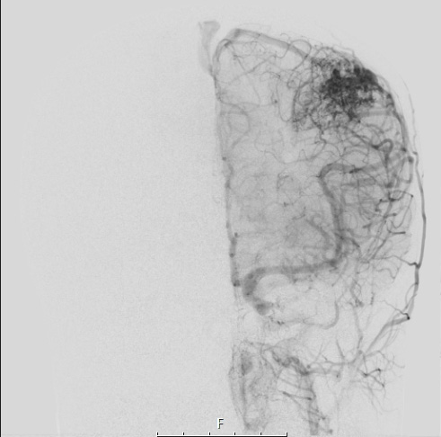 34A7 AVM, hybrid vessels (Case 34) Angiogram LCCA W - Copy
