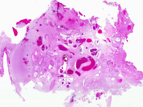 34B1 AVM, hybrid vessels (Case 34) H&E WM