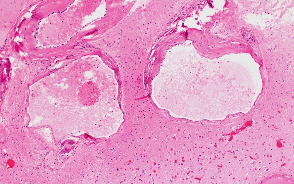 34B3 AVM, hybrid vessels (Case 34) H&E 10x 2