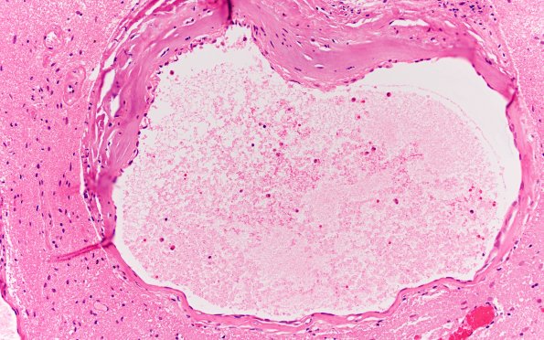 34B4 AVM, hybrid vessels (Case 34) H&E 20x 2