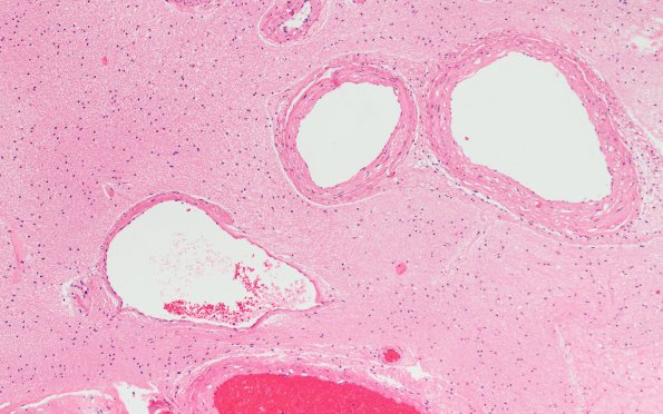 34B5 AVM, hybrid vessels (Case 34) H&E 10x